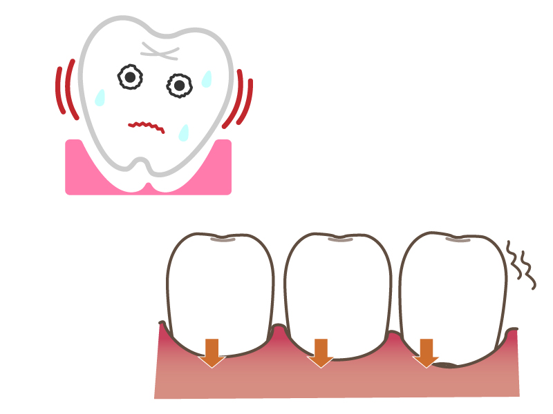 歯の収縮と移動