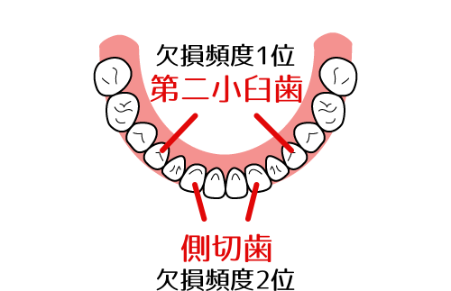 欠損歯を放置するリスク